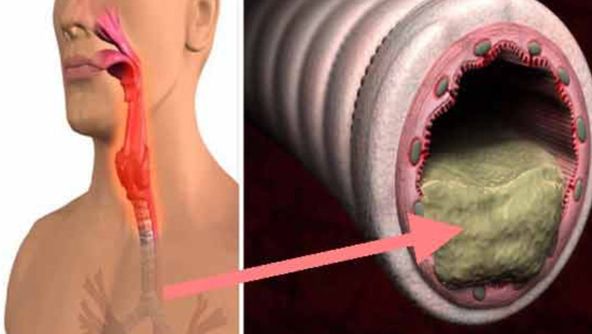 Cum scapi de flegma acumulată în nas sau gât